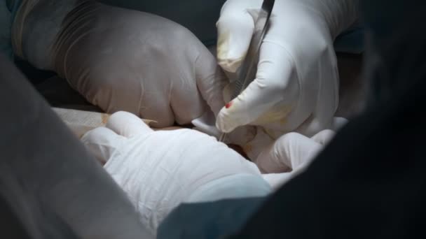 Operação Cirúrgica Perto Acção Cirurgião Mãos Realizando Operação Com Ferramentas — Vídeo de Stock