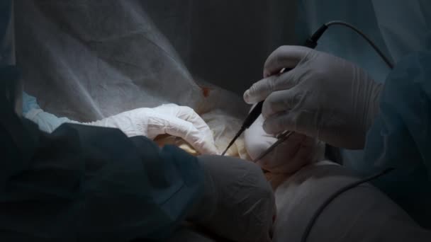 心臓外科医とチームは 心臓切除術をしています アクション 外科医のカルテル化とプロのツールを使用する — ストック動画