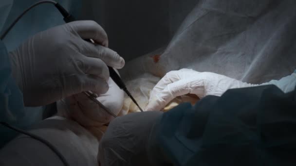 Kardiochirurg Zespół Wykonują Medianę Sternotomii Akcja Chirurg Kauteryzujący Wykorzystujący Profesjonalne — Wideo stockowe