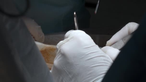 Закрытие Рук Врачей Работающих Пациентом Выполняющих Операцию Начали Стерильная Униформа — стоковое видео
