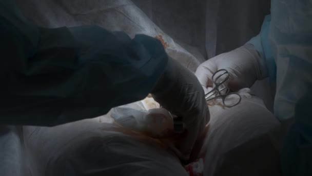 医療処置中に開いた傷を引き起こす専門外科医の閉鎖 アクション 専門機器を使用したクリーンユニフォームの医師 — ストック動画