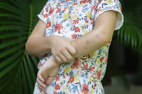 Маленькой Девочки Кожная Сыпь Аллергии Укусов Комаров — стоковое фото
