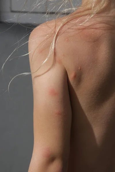 Kislánynak Allergiás Vagy Szúnyogcsípéses Bőrkiütése Van — Stock Fotó