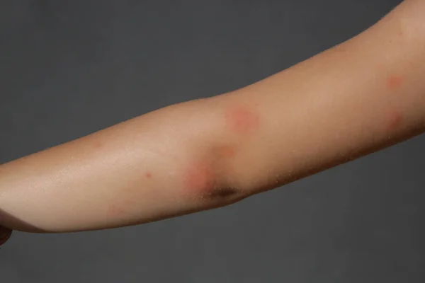 小さな女の子はアレルギーや蚊の刺されから皮膚発疹を持っています — ストック写真