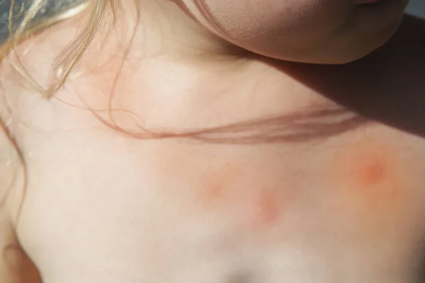 Meisje Heeft Huiduitslag Van Allergie Muggenbeten — Stockfoto