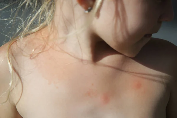 Liten Flicka Har Hudutslag Från Allergi Eller Myggbett — Stockfoto