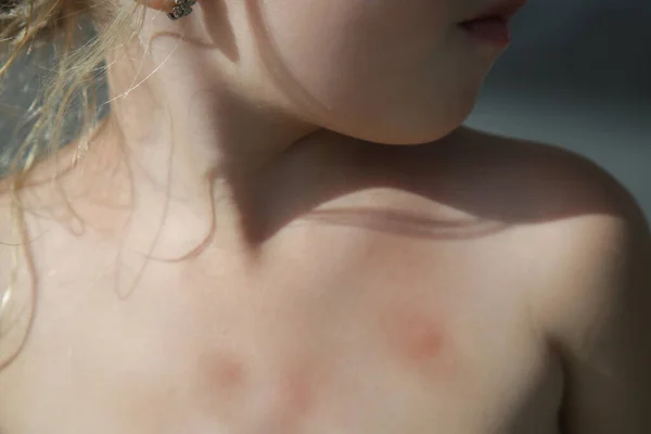 Little Girl Has Skin Rash Allergy Mosquito Bites — Stock Photo, Image
