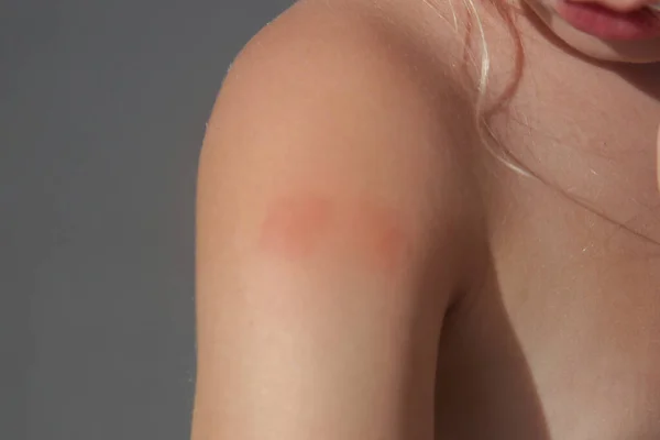 Mała Dziewczynka Wysypkę Skórną Alergii Lub Ugryzień Komarów — Zdjęcie stockowe