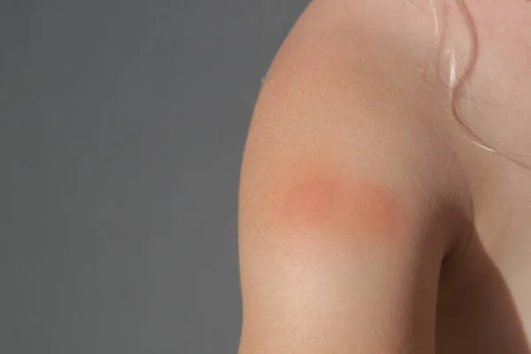 小さな女の子はアレルギーや蚊の刺されから皮膚発疹を持っています — ストック写真