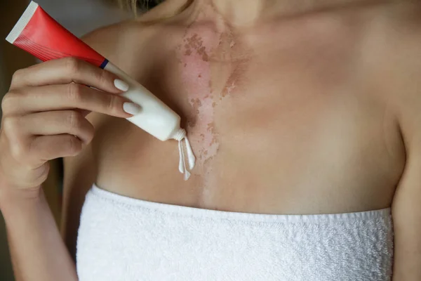 Γυναίκα Applaying Αλοιφή Για Κάψιμο Του Δέρματος Στο Στήθος Της — Φωτογραφία Αρχείου