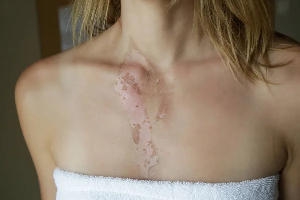 A second-degree burn with peeling skin on woman\'s chest