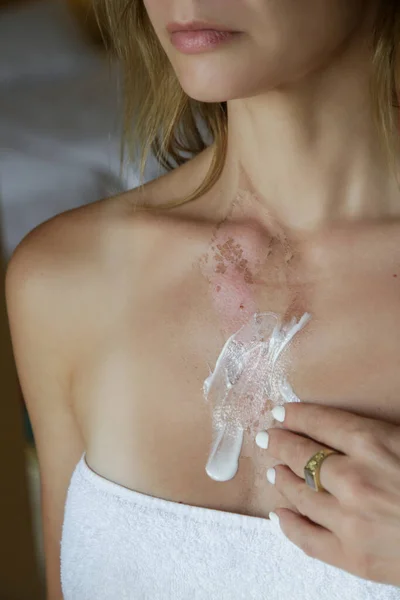 Woman applaying ointment on skin burn on her chest