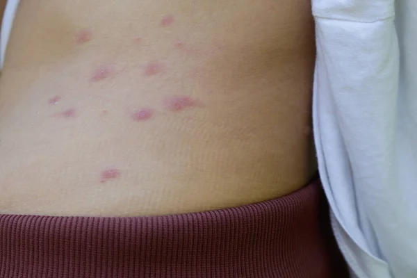Röda Svullna Och Kliande Fläckar Huden Orsakade Insektsbett Eller Allergi — Stockfoto