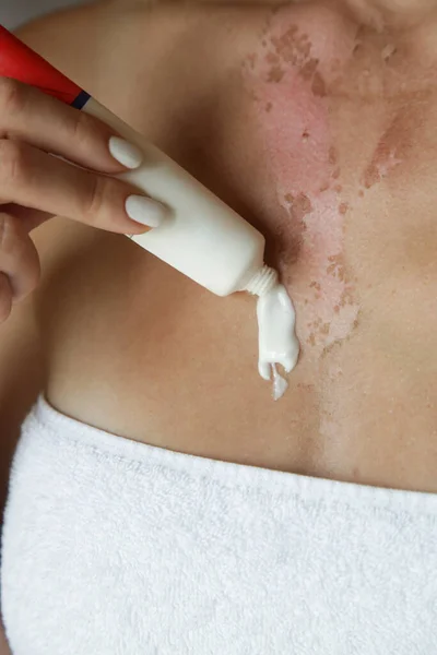 Woman applaying ointment on skin burn on her chest