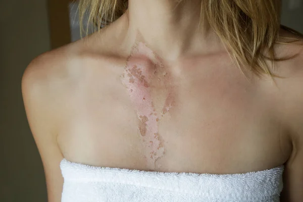 A second-degree burn with peeling skin on woman\'s chest