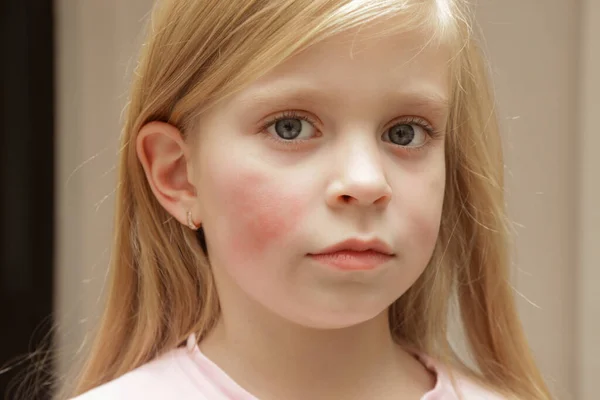Zaczerwienienie Policzkach Dziecka Spowodowane Wypryskiem Suchością Skóry Lub Alergią Obrazek Stockowy