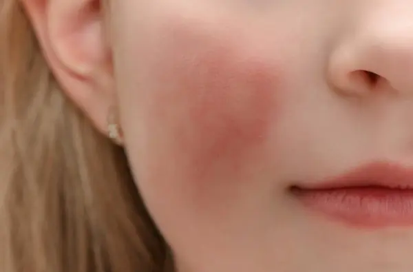 Zaczerwienienie Policzkach Dziecka Spowodowane Wypryskiem Suchością Skóry Lub Alergią Zdjęcie Stockowe