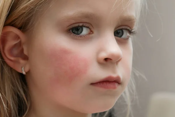 Zaczerwienienie Policzkach Dziecka Spowodowane Wypryskiem Suchością Skóry Lub Alergią Obraz Stockowy