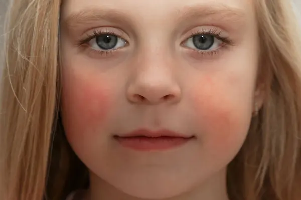 Zaczerwienienie Policzkach Dziecka Spowodowane Wypryskiem Suchością Skóry Lub Alergią Obrazek Stockowy
