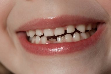 Sevimli anaokulu kızı ilkokul dişini gösteriyor.