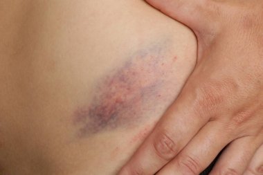 Close up view of a nasty bruise clipart