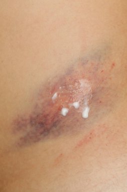 Kötü bir morluğun yakın görüntüsü.