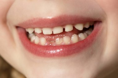 Sevimli anaokulu kızı ilkokul dişini gösteriyor.