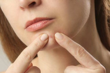 Çenesinde sivilce olan genç bir kadın. İltihaplı sivilce ve akne sonrası lekeler, kızarıklık. Hormonal yetişkin sivilcesi.