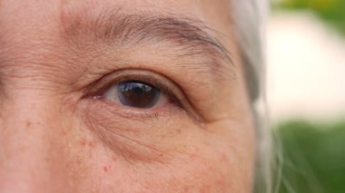 Close up of the senile cataract during eye examination. A white cloudy disc is seen in black eye circle, mature cataract, nuclear sclerosis cataract. Close up half face view