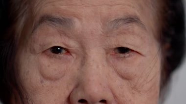 Close up of the senile cataract during eye examination. A white cloudy disc is seen in black eye circle, mature cataract, nuclear sclerosis cataract. Close up half face view