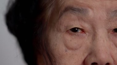 Close up of the senile cataract during eye examination. A white cloudy disc is seen in black eye circle, mature cataract, nuclear sclerosis cataract. Close up half face view