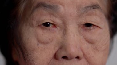 Close up of the senile cataract during eye examination. A white cloudy disc is seen in black eye circle, mature cataract, nuclear sclerosis cataract. Close up half face view
