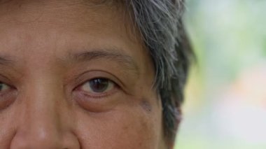 Close up of the senile cataract during eye examination. A white cloudy disc is seen in black eye circle, mature cataract, nuclear sclerosis cataract. Close up half face view