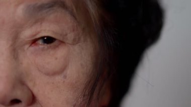 Close up of the senile cataract during eye examination. A white cloudy disc is seen in black eye circle, mature cataract, nuclear sclerosis cataract. Close up half face view
