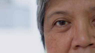 Close up of the senile cataract during eye examination. A white cloudy disc is seen in black eye circle, mature cataract, nuclear sclerosis cataract. Close up half face view