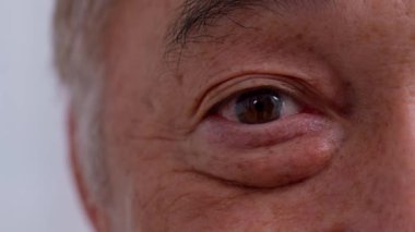 Close up of the senile cataract during eye examination. A white cloudy disc is seen in black eye circle, mature cataract, nuclear sclerosis cataract. Close up half face view