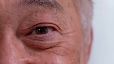 Close up of the senile cataract during eye examination. A white cloudy disc is seen in black eye circle, mature cataract, nuclear sclerosis cataract. Close up half face view