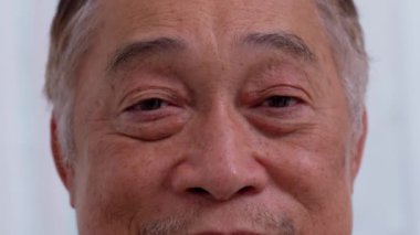 Close up of the senile cataract during eye examination. A white cloudy disc is seen in black eye circle, mature cataract, nuclear sclerosis cataract. Close up half face view