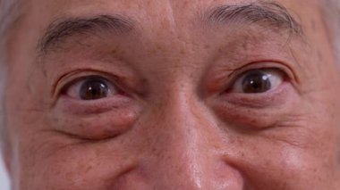 Close up of the senile cataract during eye examination. A white cloudy disc is seen in black eye circle, mature cataract, nuclear sclerosis cataract. Close up half face view