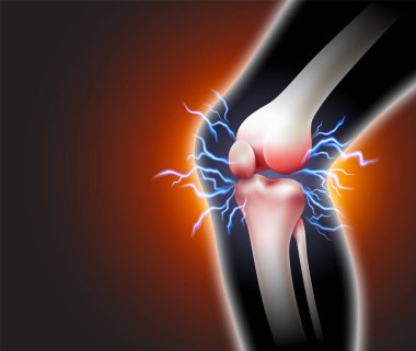 Knee pain and pain throbbing into the bone Inflammatory disease of the knee joint on black background. Realistic 3d vector file. clipart