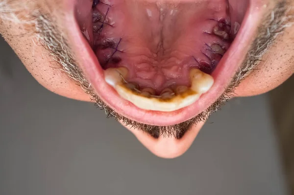上颌骨的细部 拔除磨牙后用牙龈缝合 门牙上有分叉 — 图库照片