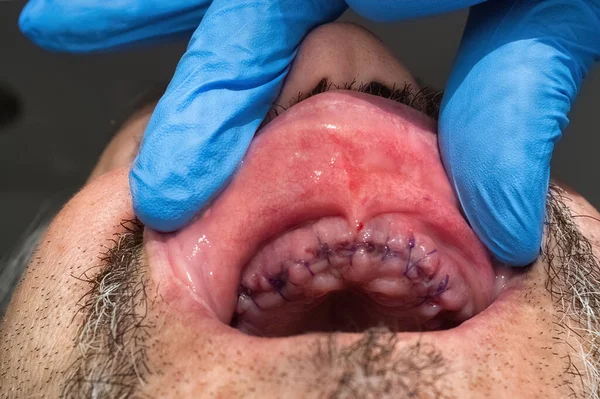 上部の男性の口蓋の詳細腸の歯の抽出後に縫い付けガム — ストック写真
