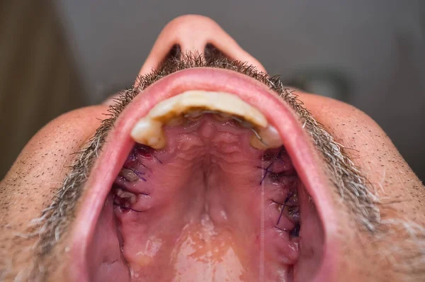 臼歯の抽出物の後に縫い付けられたガムで上の男性の口蓋の詳細 乳歯に分割して — ストック写真