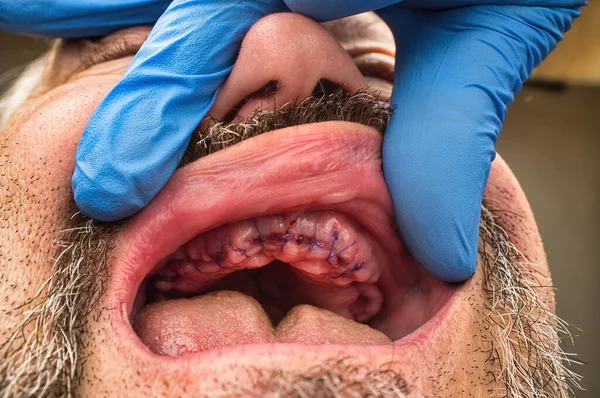 Верхній Чоловічий Піднебіння Пересадками Гумки Після Вилучення Всіх Зубів — стокове фото