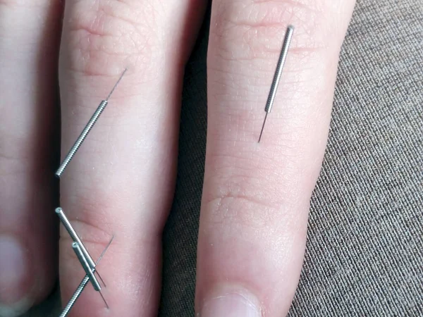 Jok Terapisi Jok Kadın Parmaklarına Iğne Batırıyor — Stok fotoğraf