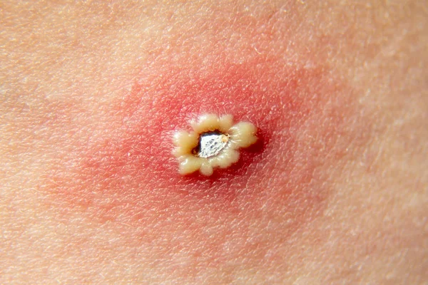 수두로 어린이의 푸석푸석 사람에게 나타나는 알레르기 — 스톡 사진