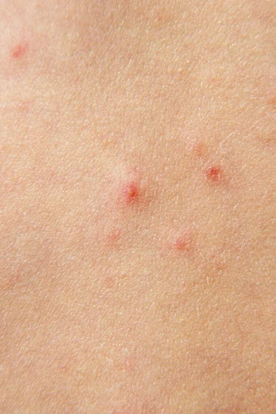 Treatment Ulcers Chicken Pox Large Purulent Sore Chicken Pox Skin — Stock Photo, Image