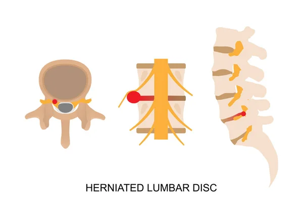 Ilustración Hernia Discal Lumbar Vista Diferente — Vector de stock