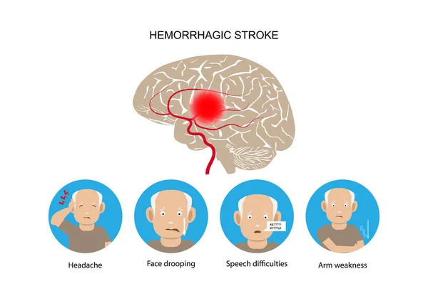 Accidente Cerebrovascular Hemorrágico Signos Síntomas Advertencia — Vector de stock