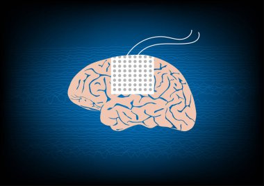 Epilepsi ameliyatında EEG veya beyin dalgalarını izlemek için beyin yüzeyinde subdural elektrot çizimi.